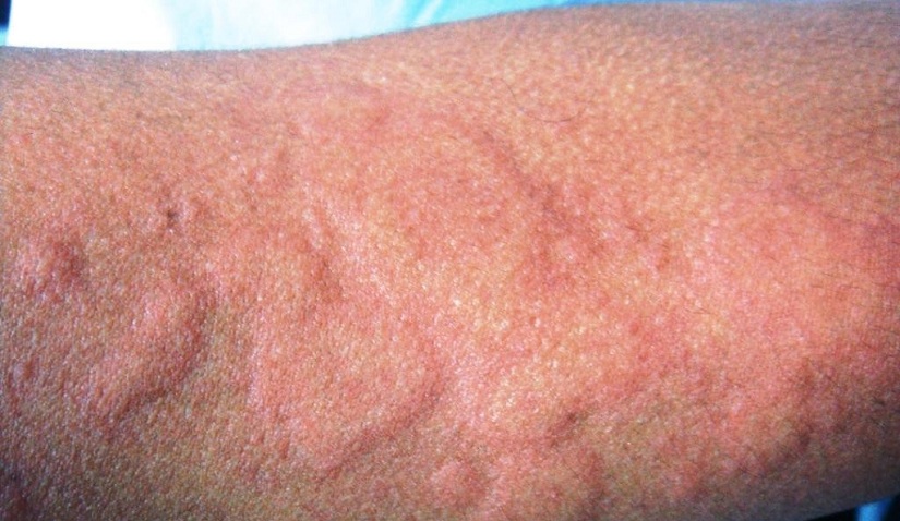 Аллергия на коже у взрослых